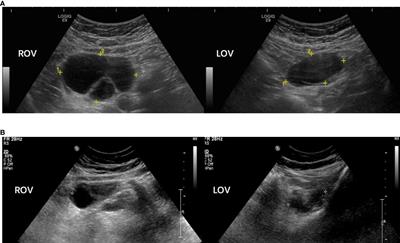 Frontiers | Clinical Characteristics And Molecular Etiology Of Partial ...